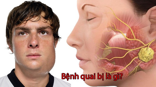 Bệnh quai bị là gì
